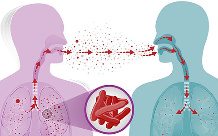 Ilustrasi-penyakit Tuberkulosis (TBC). (ist)