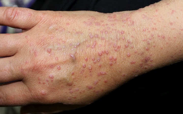 Ilustrasi - kondisi kulit yang mengalami kelainan seperti lesi kulit dan ruam. (gemapos/Halodoc)